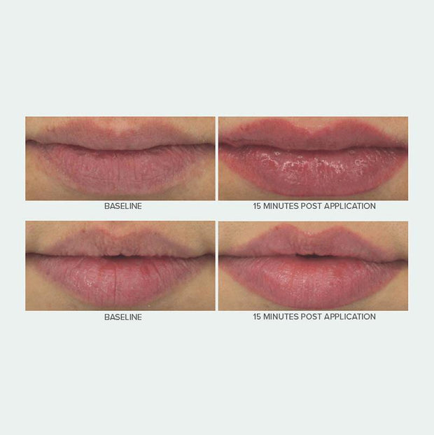 before and after of the lips baseline